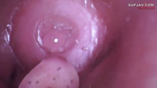 室内 · 全裸 · 仰卧 · 内窥镜 · 子宫颈特写 · 内窥视角 · 妇科视角